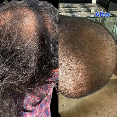 Anti-Hairfall Treatment