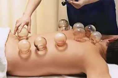 Cupping Therapy